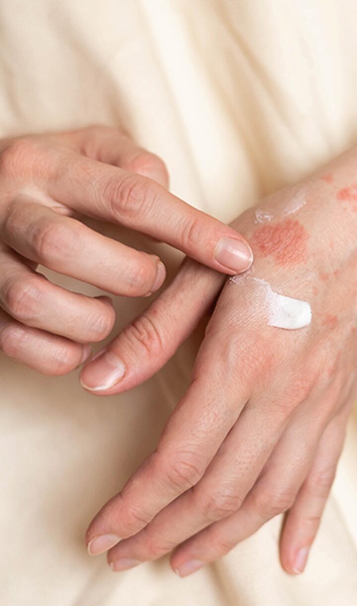 Eine Hand trägt Creme auf eine zweite Hand mit geröteter Haut auf.